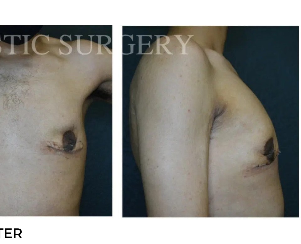 Procedure before and after - after