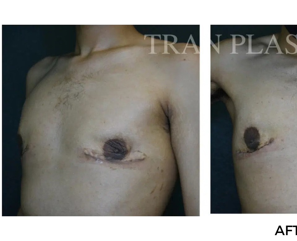 Procedure before and after - before
