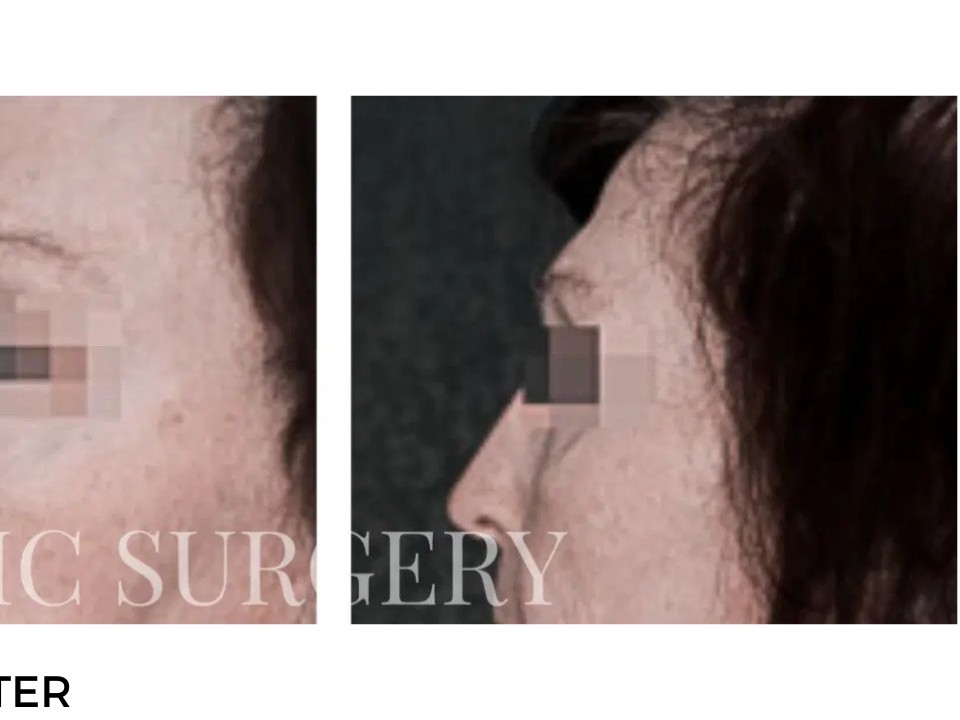 Procedure before and after - after
