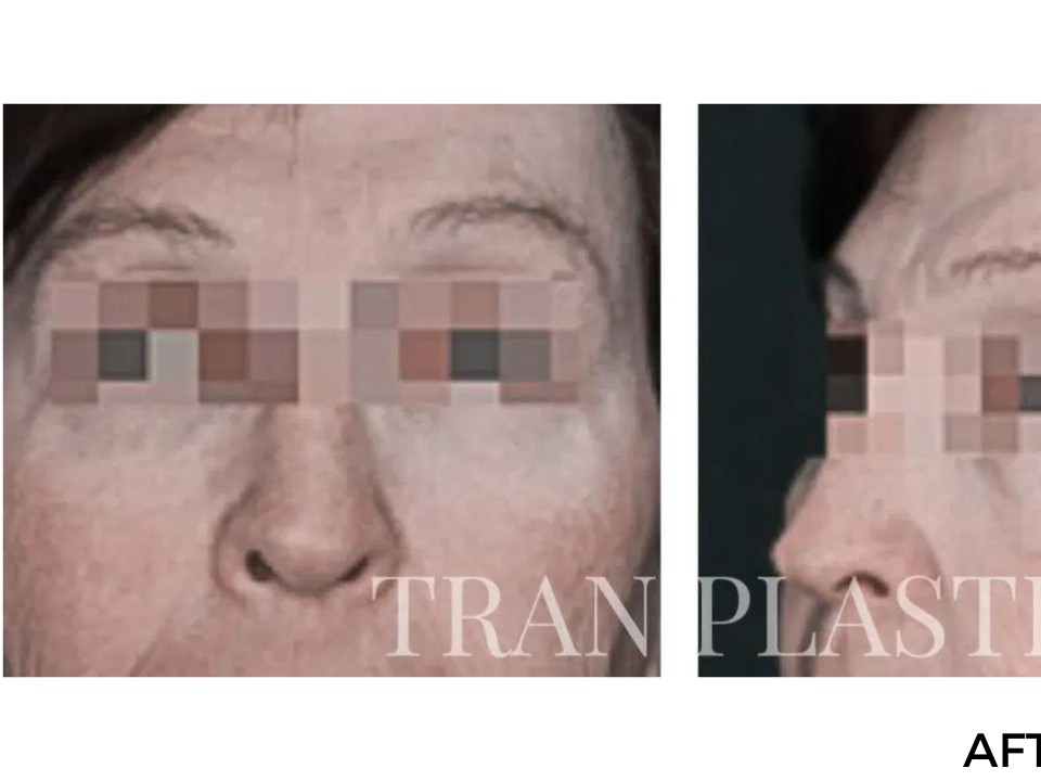 Procedure before and after - before