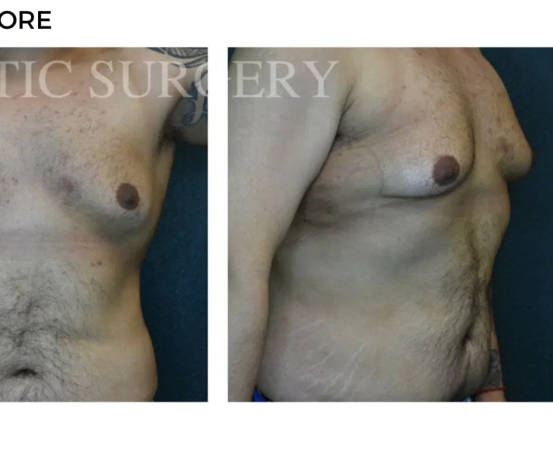Procedure before and after - after