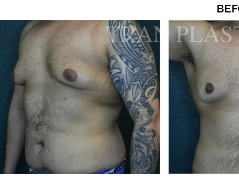 Procedure before and after - before