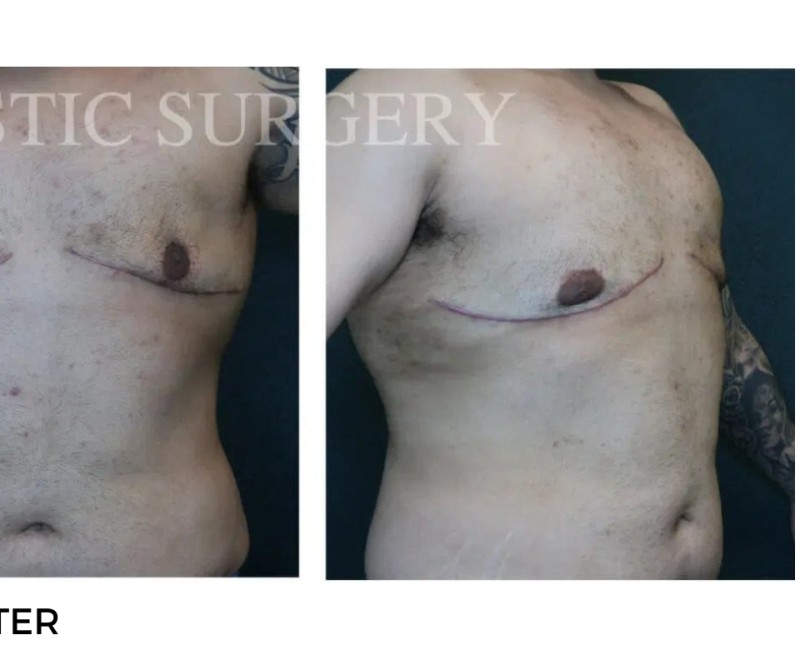 Procedure before and after - after