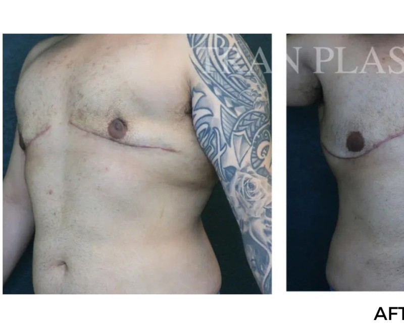 Procedure before and after - before