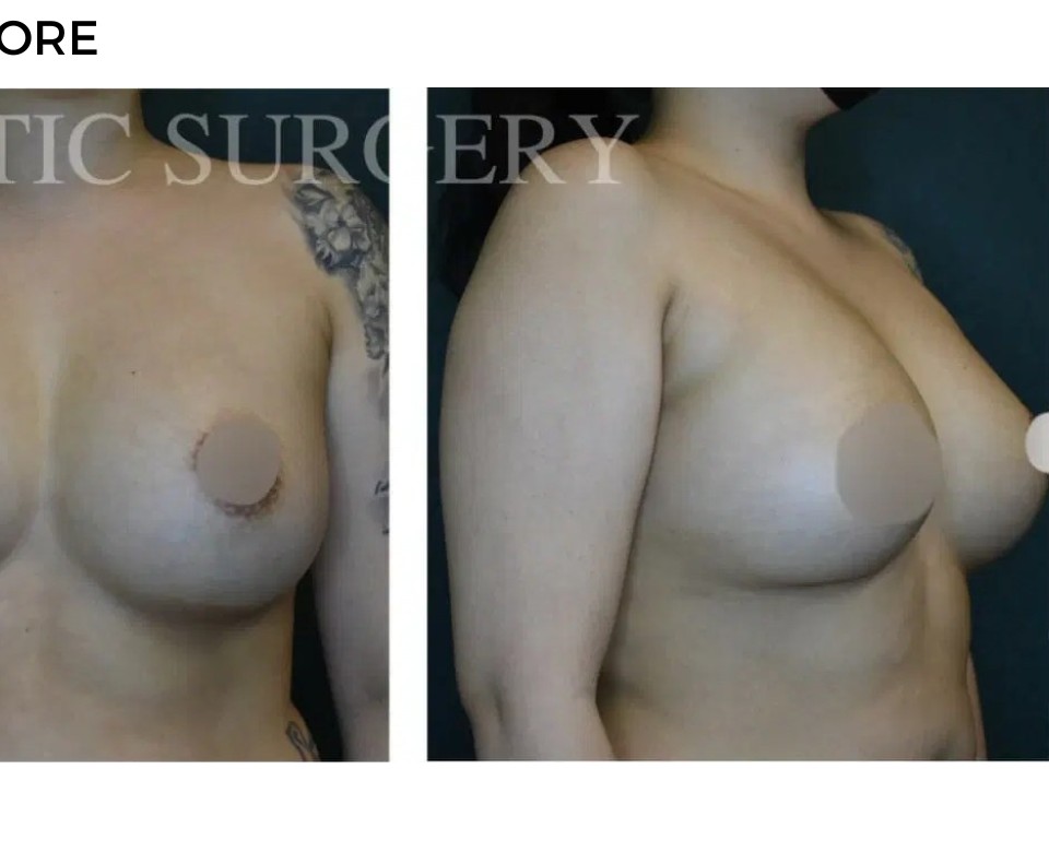 Procedure before and after - after