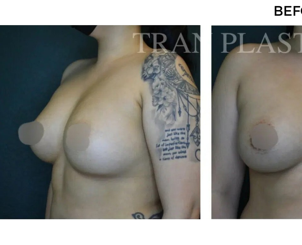Procedure before and after - before