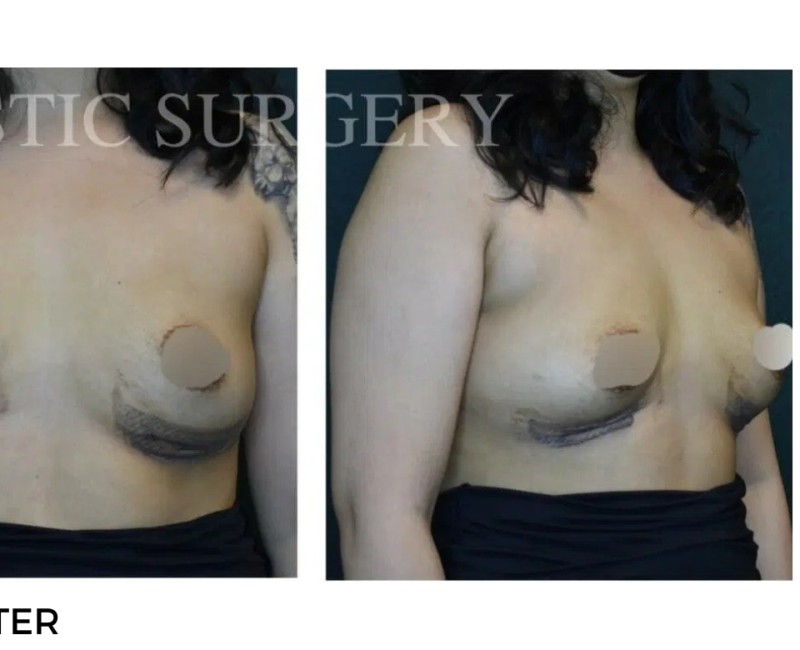Procedure before and after - after