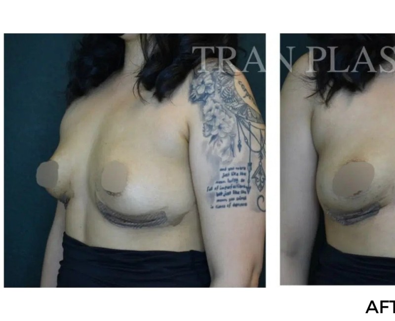 Procedure before and after - before
