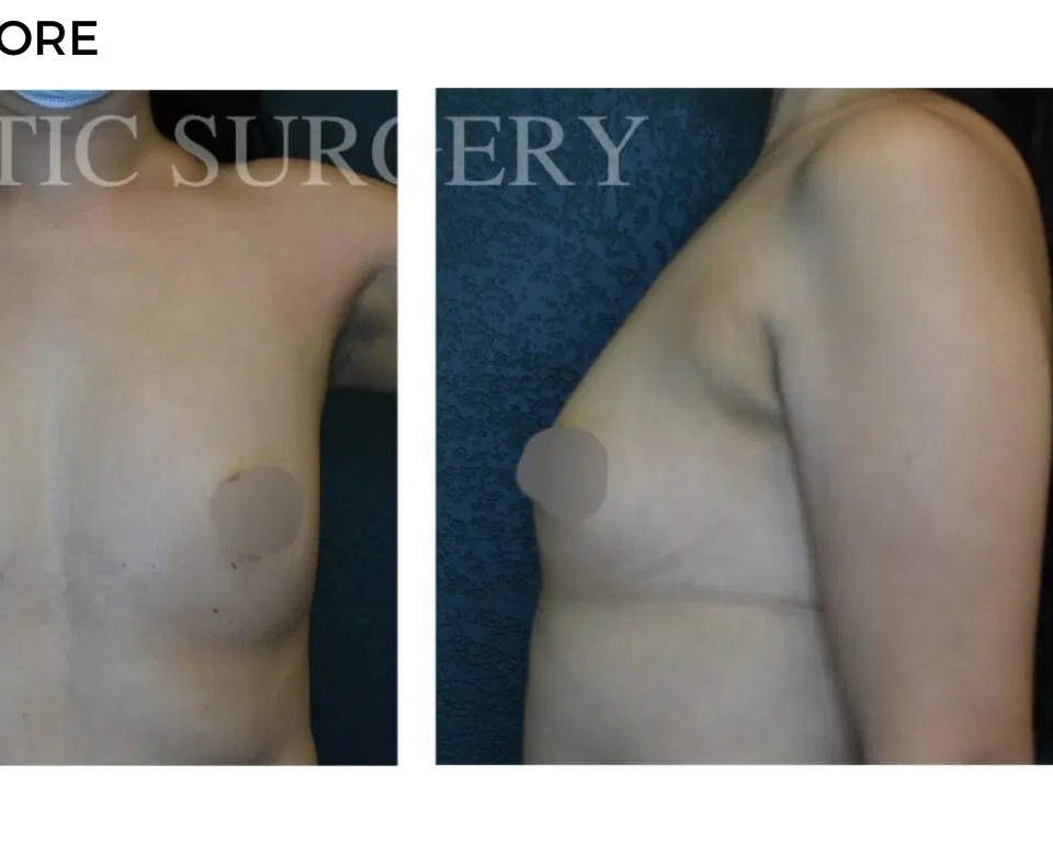 Procedure before and after - after