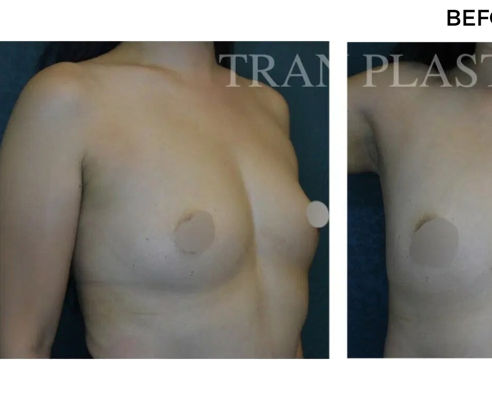 Procedure before and after - before