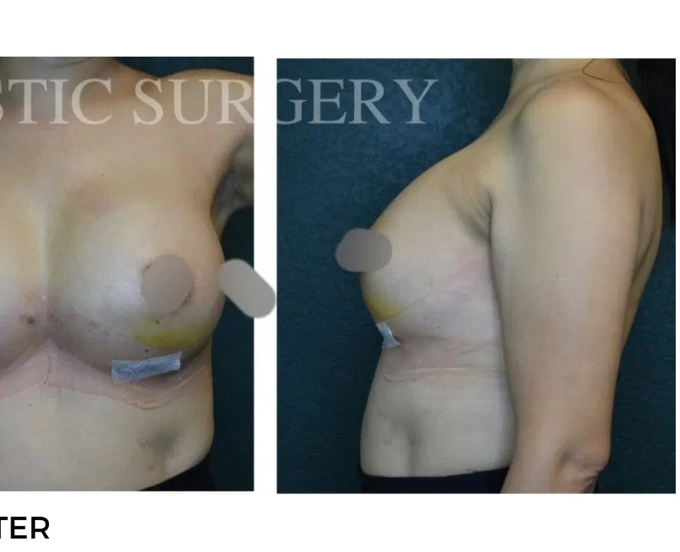 Procedure before and after - after