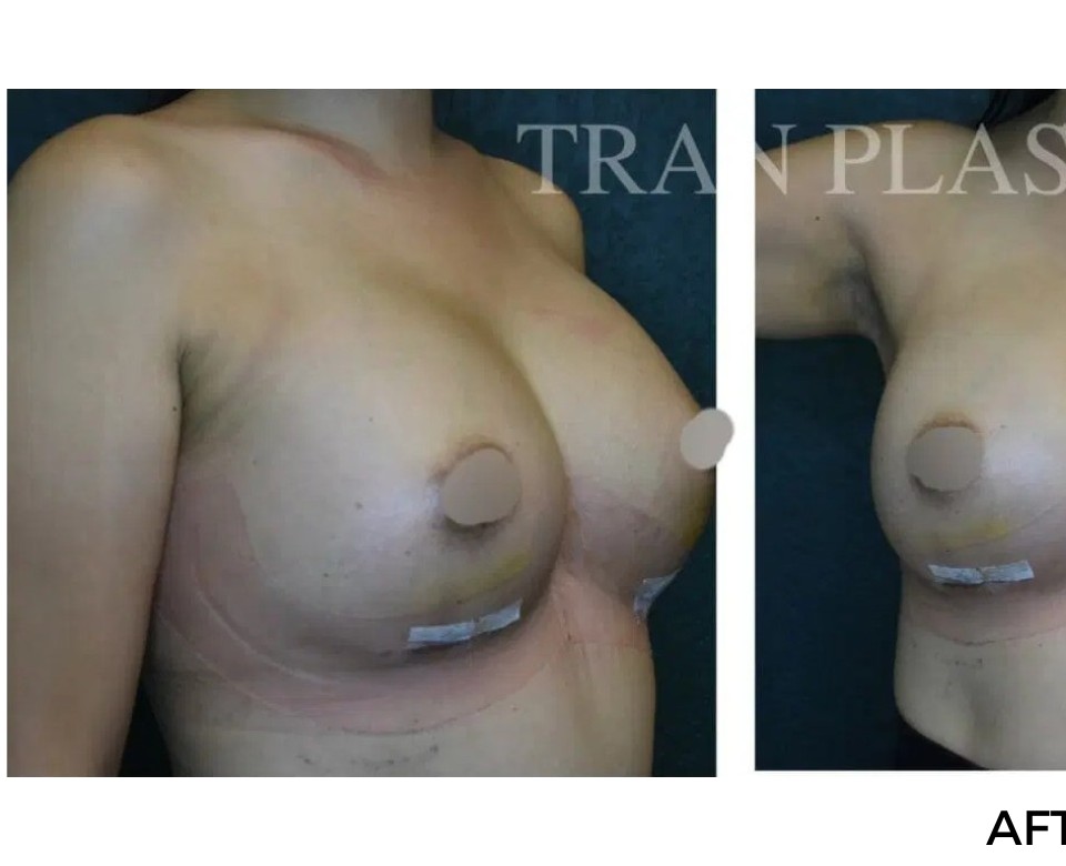Procedure before and after - before