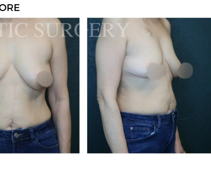 Procedure before and after - after