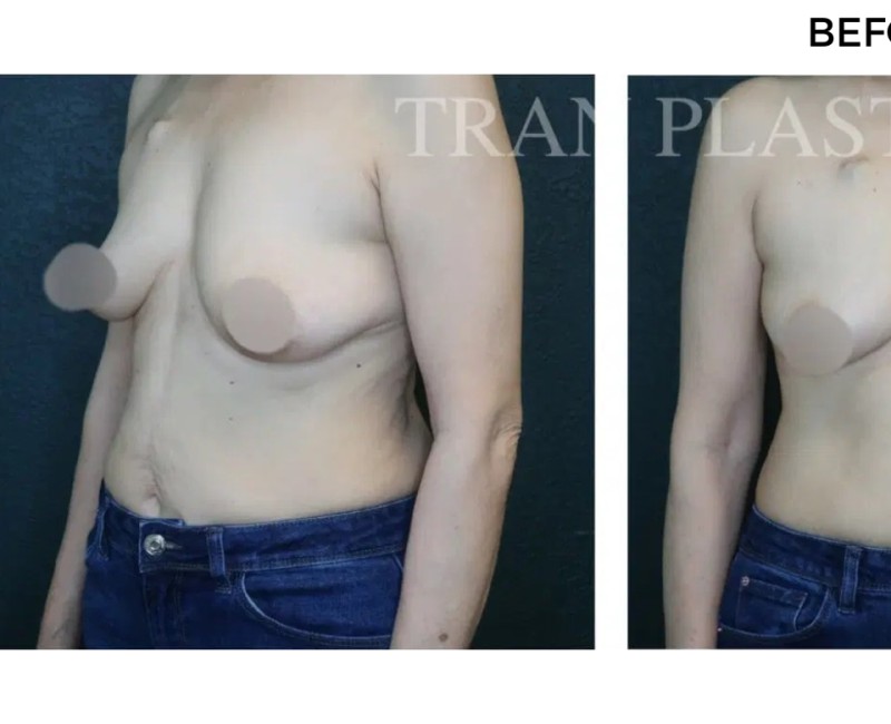 Procedure before and after - before
