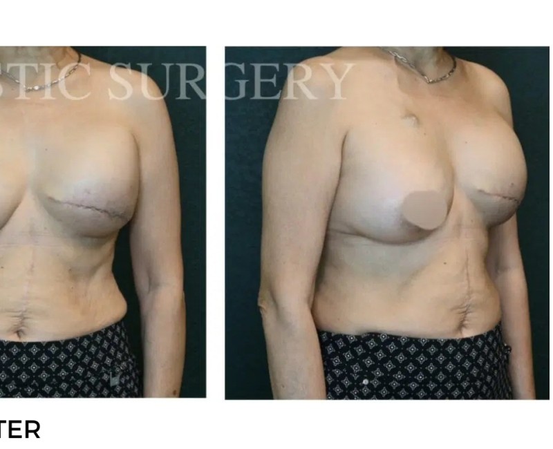 Procedure before and after - after