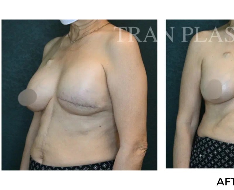 Procedure before and after - before