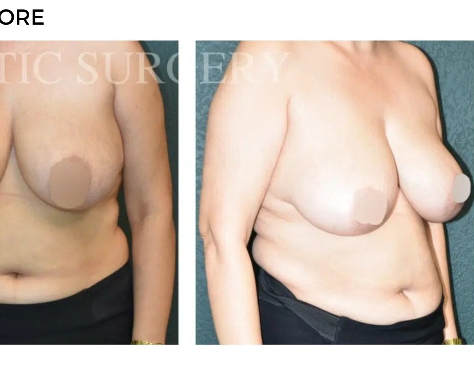 Procedure before and after - after