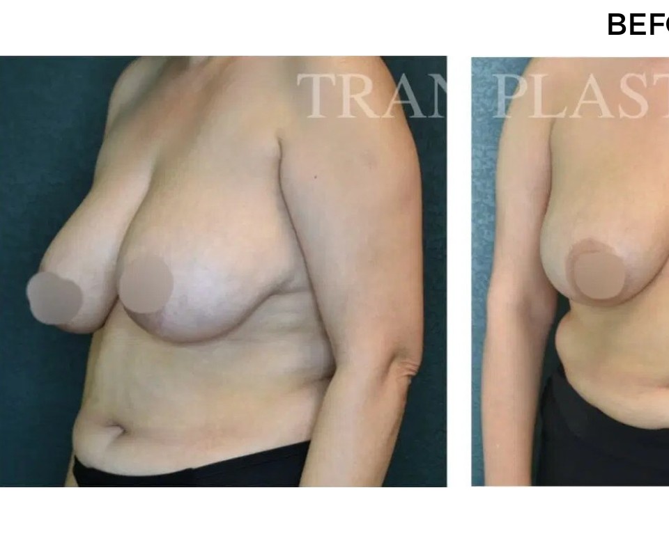 Procedure before and after - before