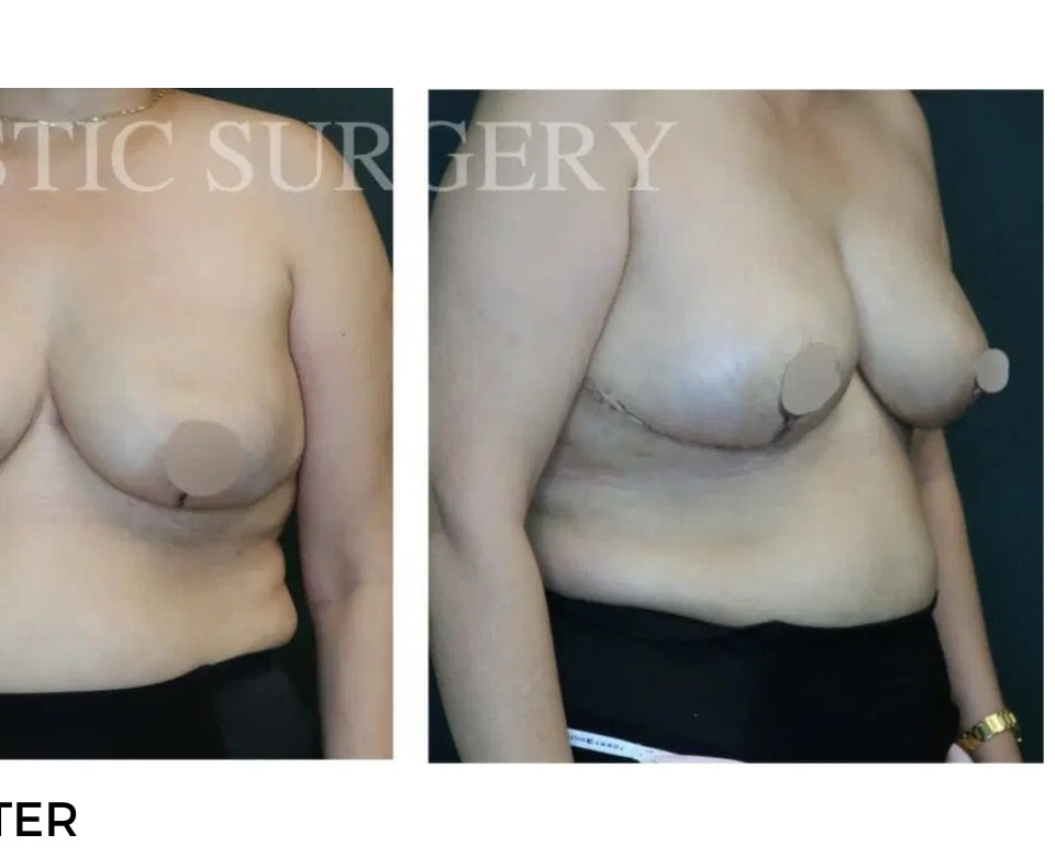 Procedure before and after - after