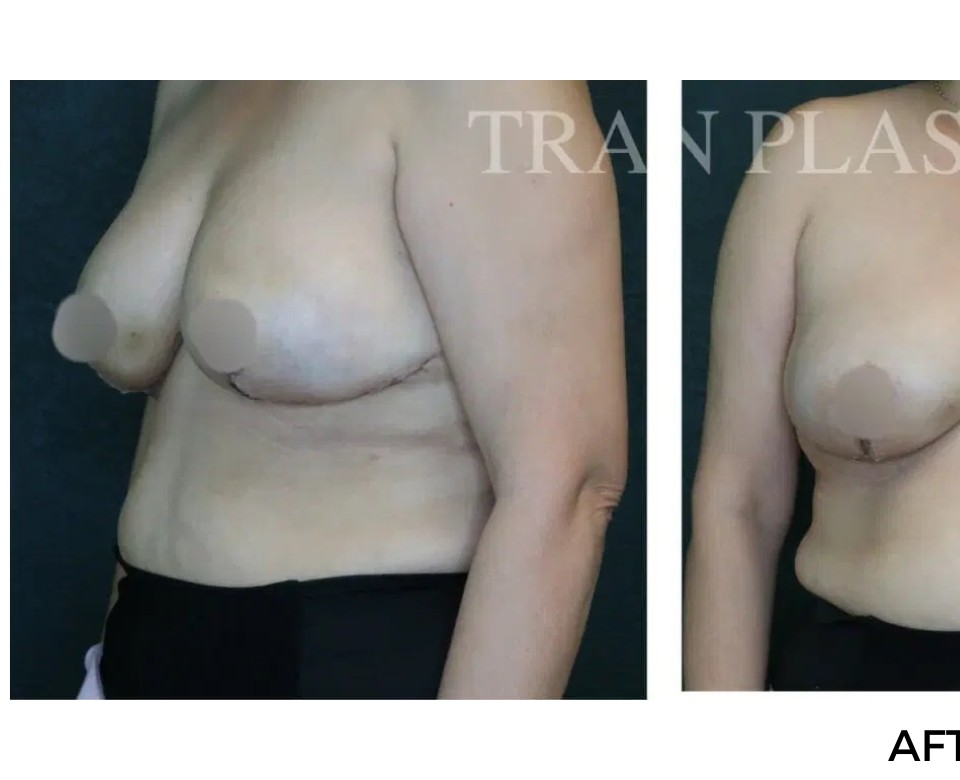 Procedure before and after - before