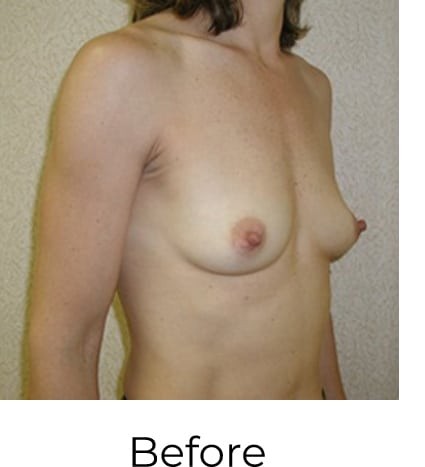 Breast Augmentation before and after - before