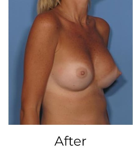Breast Augmentation before and after - after