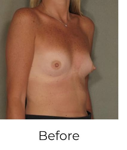 Breast Augmentation before and after - before