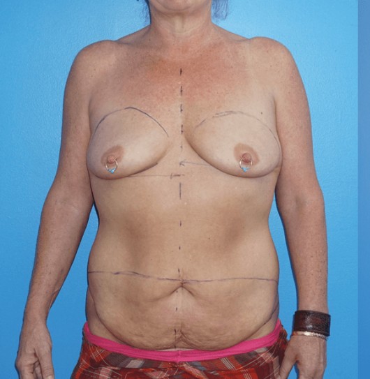 Procedure before and after - before