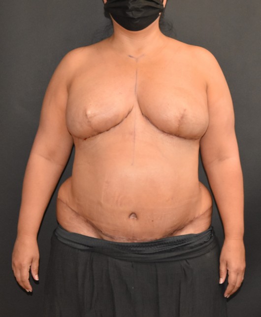 Procedure before and after - after