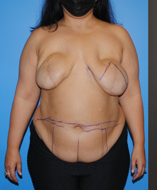 Procedure before and after - before