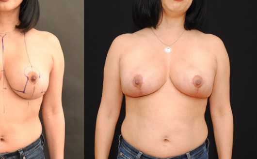 Breast Reduction before and after - after