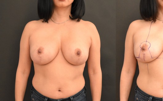 Breast Reduction before and after - before