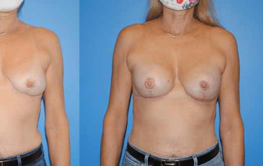 Procedure before and after - after