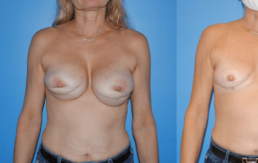 Procedure before and after - before