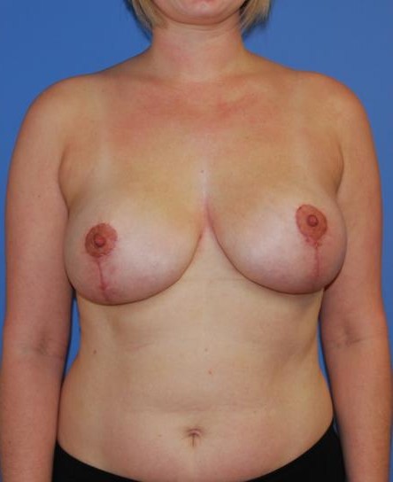 Mastopexy Augmentation Reduction before and after - after