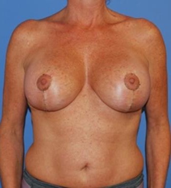 Mastopexy Augmentation Reduction before and after - after