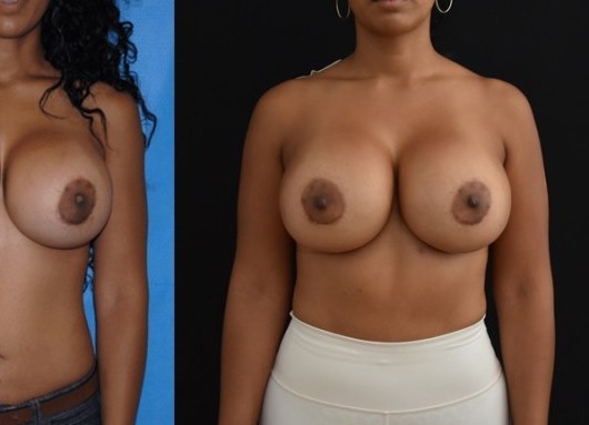 Breast Implant Removal and Replacement Lift before and after - after