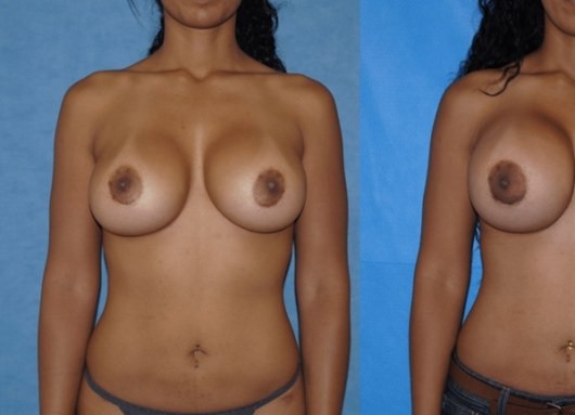 Breast Implant Removal and Replacement Lift before and after - before