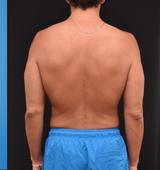 Liposuction after — Dr. Brian Dickinson