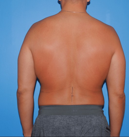 Liposuction before — Dr. Brian Dickinson