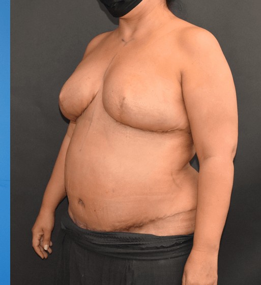 Procedure before and after - after