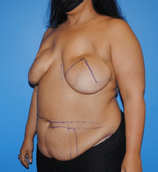 Procedure before and after - before