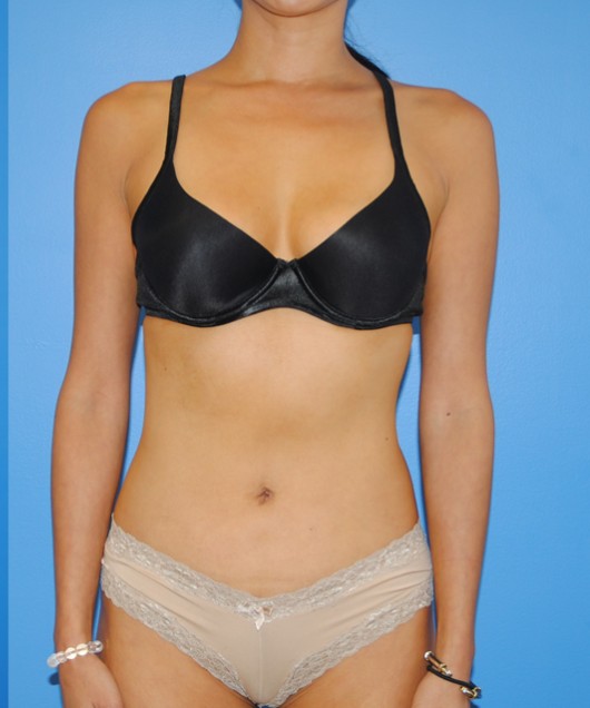 Liposuction after — Dr. Brian Dickinson