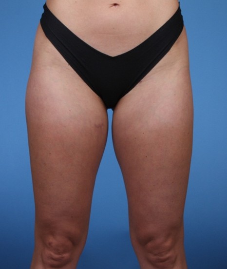 Liposuction after — Dr. Brian Dickinson