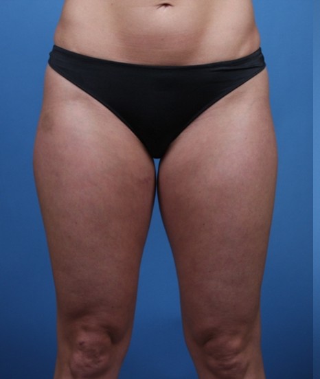 Liposuction before — Dr. Brian Dickinson
