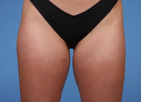 Liposuction after — Dr. Brian Dickinson