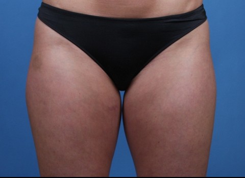 Liposuction before — Dr. Brian Dickinson