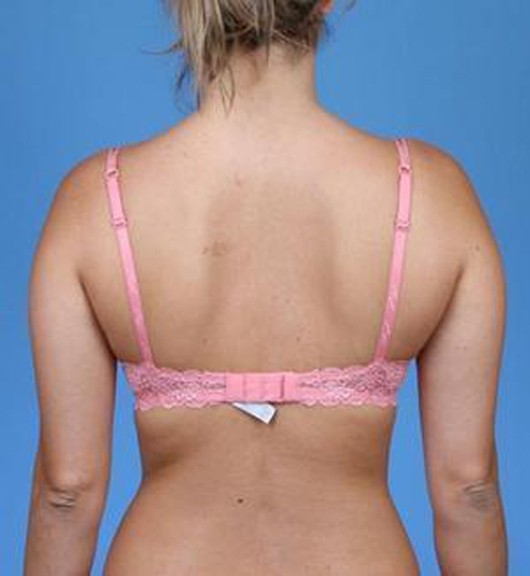 Liposuction before — Dr. Brian Dickinson