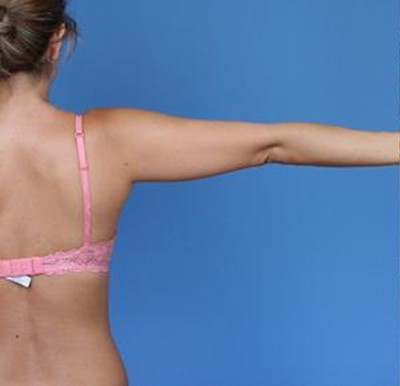 Liposuction before — Dr. Brian Dickinson