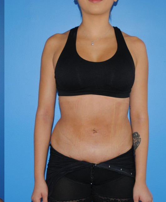 Liposuction after — Dr. Brian Dickinson